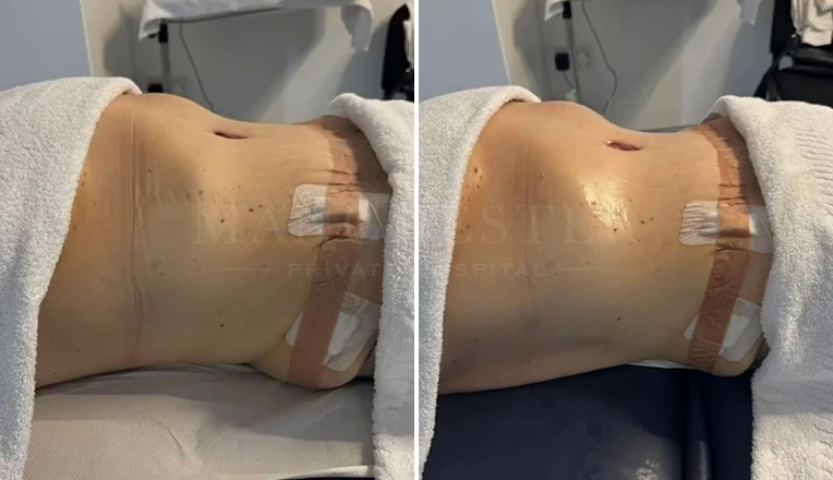 MLD Massage post tummy tuck