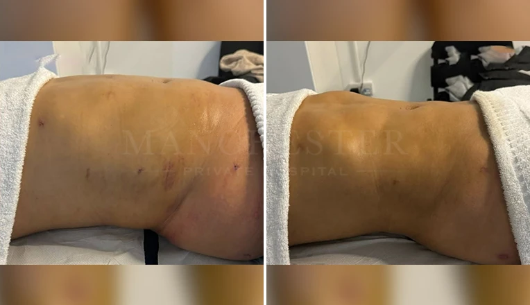 Results After 4 MLD Massages, Post op from Vaser Liposuction on Abdomen and Flanks