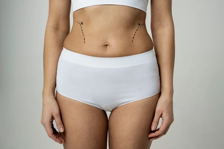 Front view of woman’s abdomen with pre-operative liposuction treatment markings on the waist and lower stomach