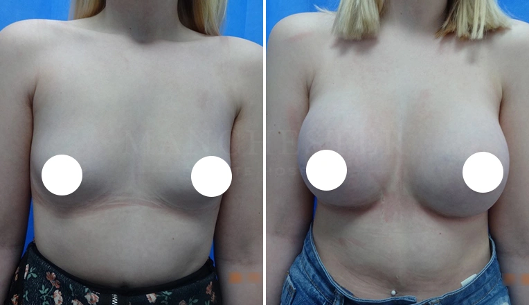Breast Augmentation Before and After Photos Gallery | Boob Job Results
