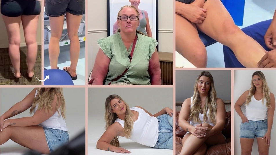 Collage of lipoedema liposuction patients featured in Manchester Private Hospital testimonials