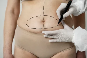 Tummy Tuck Belly Button: What Happens During Surgery?