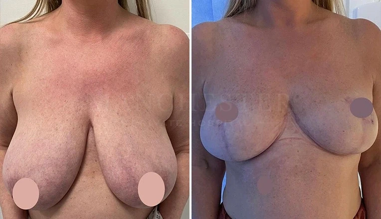 breast-reduction-before-and-after