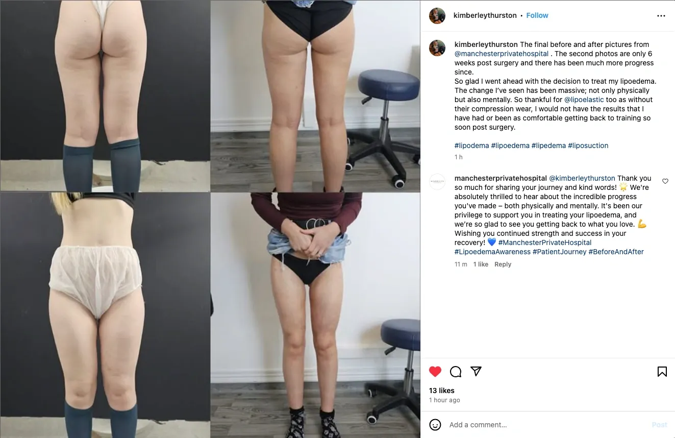 lipoedema-patient-experience